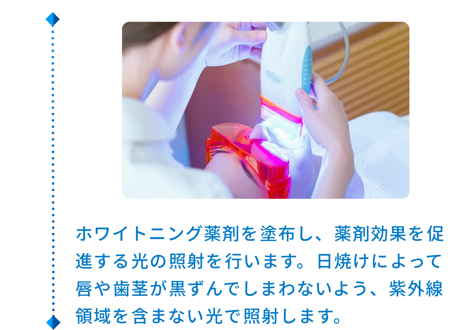 ホワイトニング薬剤を塗布し、薬剤効果を促進する光の照射を行います。日焼けによって唇や歯茎が黒ずんでしまわないよう、紫外線領域を含まない光で照射します。
