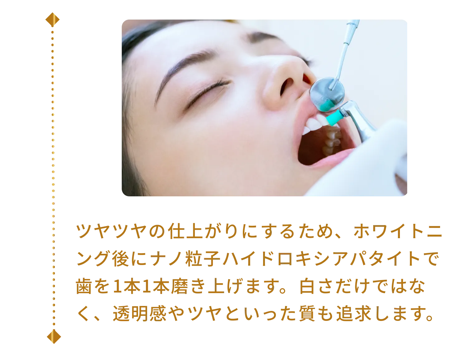 ツヤツヤの仕上がりにするため、ホワイトニング後にナノ粒子ハイドロキシアパタイトで歯を1本1本磨き上げます。白さだけではなく、透明感やツヤといった質も追求します。